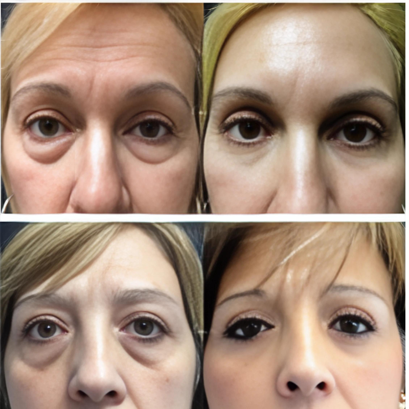 Máscara de Colágeno Verisol - Retire Imperfeições Faciais |COMPRE 1 LEVE 3|Frete Grátis