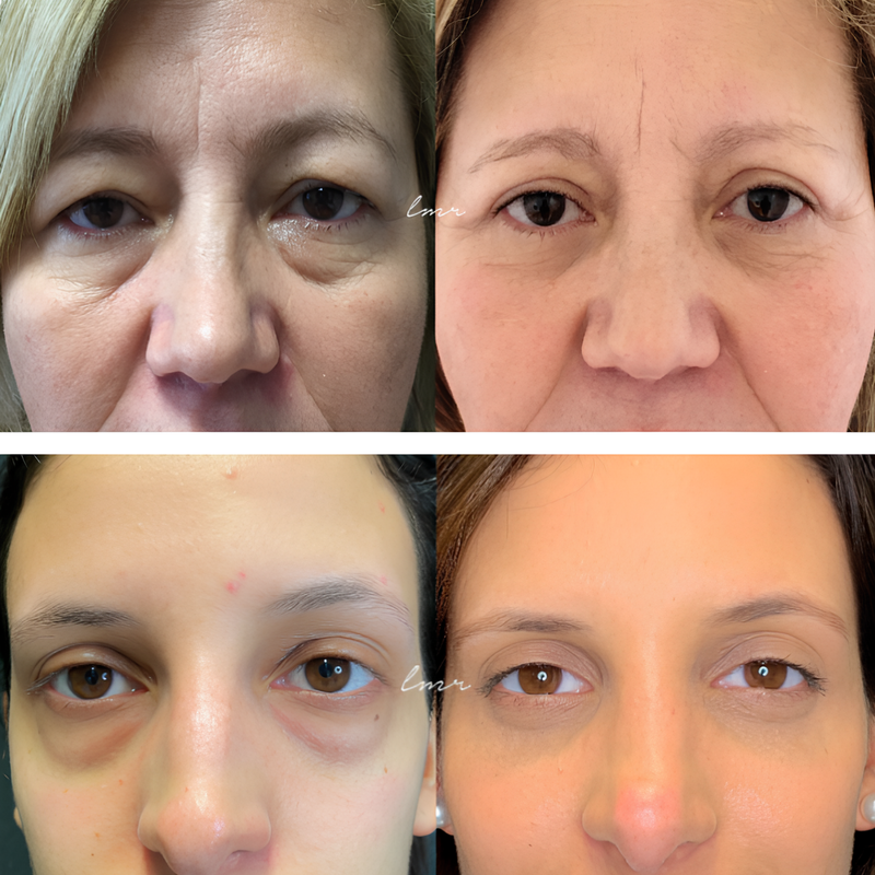 COMPRE 1 LEVE 2 - VisionSkin™ 3D  Remove Bolsas , Anti-Envelhecimento, Rugas e Inchaço