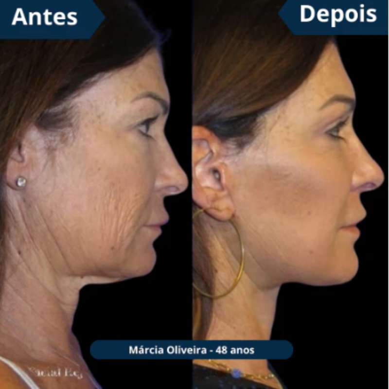 KIT 10 UNIDADES Máscaras CollagenBoost - ATIVOS DO BOTOX | Frete Grátis